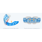 Myobrace pour les adolescents étape 2 - T2