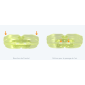 Myobrace dentition permanente classe III étape 1 - P-3N