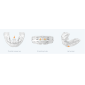 Myobrace Adult Aligner étape2 – AA2